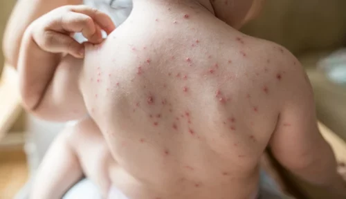 Read more about the article Chicken pox How Many Days to recover