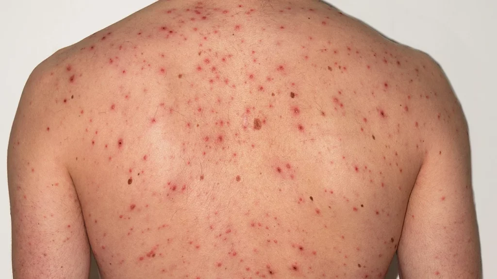 Read more about the article How Many Days to Recover From Chicken Pox